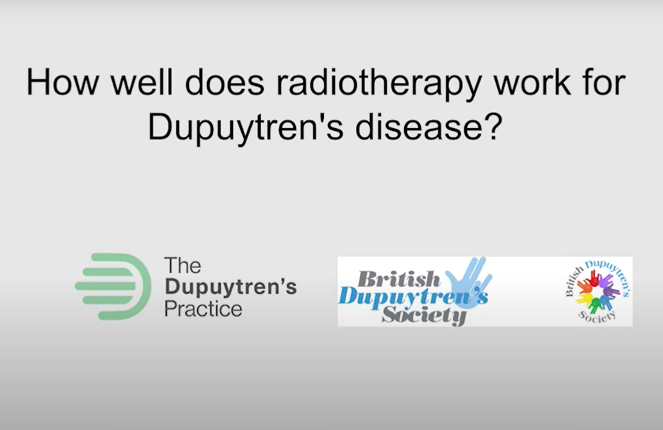 Exploring the effectiveness of radiotherapy treatment for dupuytren's disease, presented by the dupuytren's practice and the british dupuytren's society.